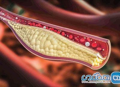 علائم وجود لخته خون خطرناک در بدن