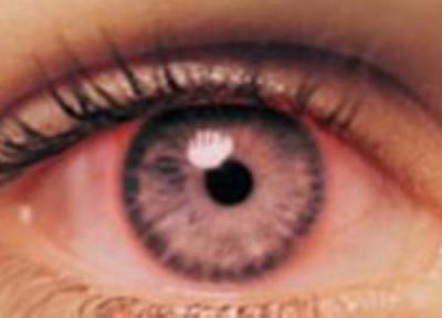 کونژیکتیویت (التهاب ملتحمه چشم) در بچه ها